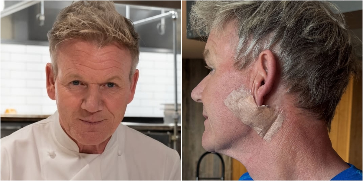 Gordon Ramsay Operasi Kanker Kulit, Ingatkan Pentingnya Sunscreen