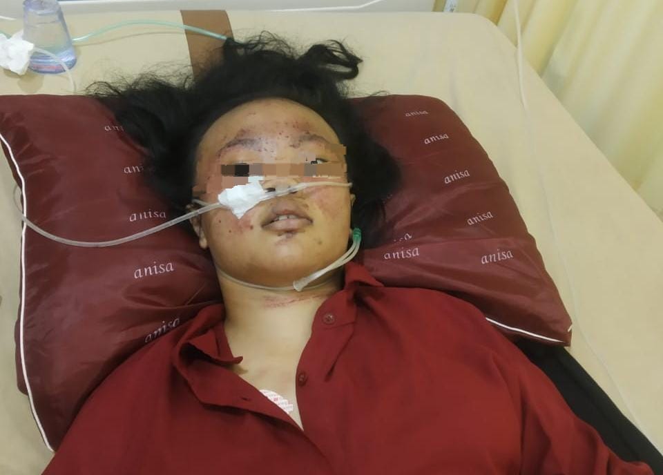 Remaja Penderita Lupus di Tanggamus Butuh Uluran Tangan: “Ay Kini Hanya Bisa Berbaring dan Menanti Keajaiban”