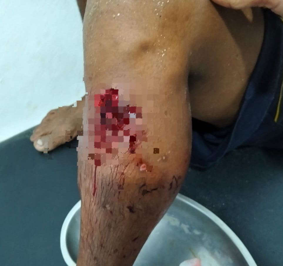 Nelayan Cukuh Balak Diserang Ikan Marlin, Moncong Tembus Lutut hingga Betis