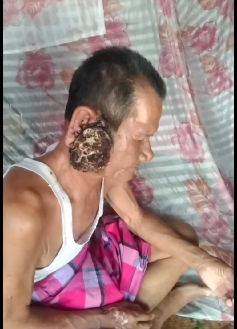 Warga Tiyuh Penumangan Idap Tumor Ganas, Terkendala Biaya Pengobatan di Tengah Perayaan HUT Tubaba