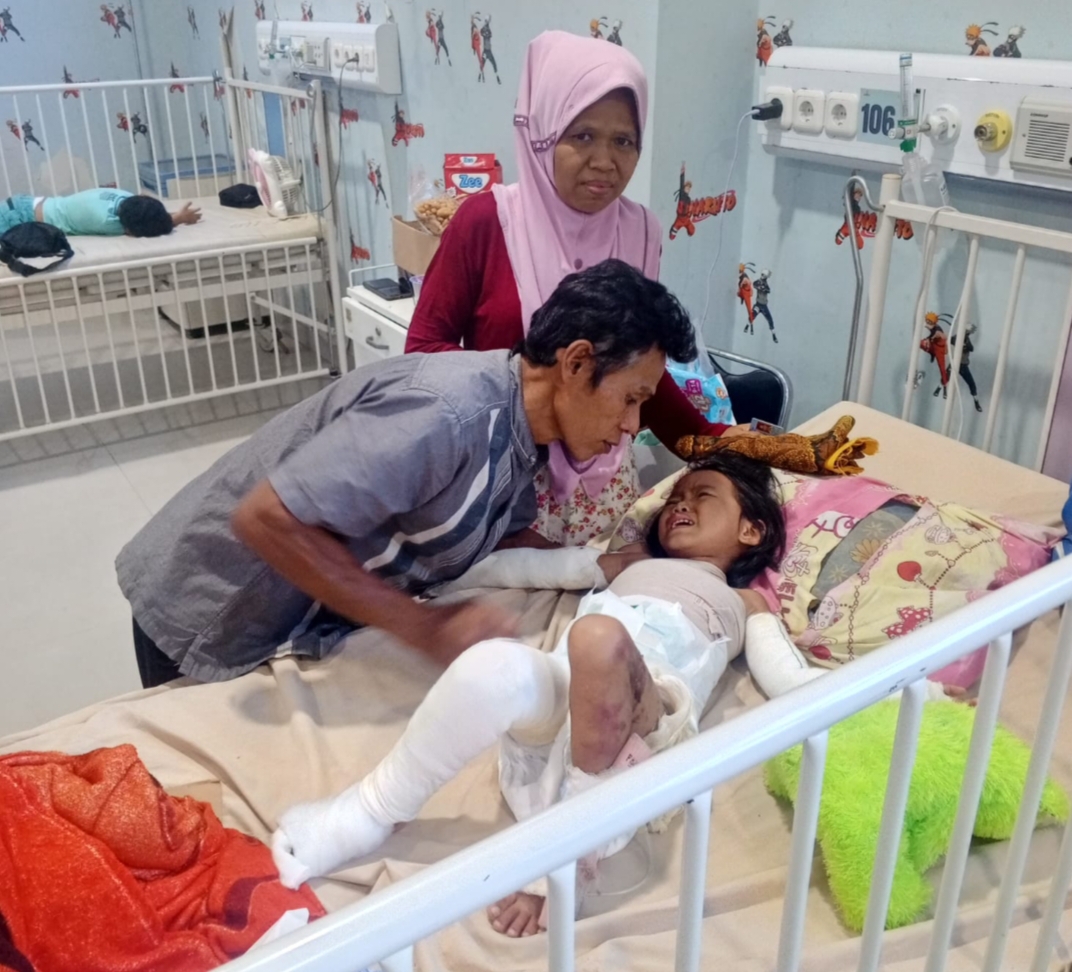 Tubuh Mungil Unfa Melepuh Tersiram Santan Mendidih, Kini Berjuang Melawan Rasa Sakit
