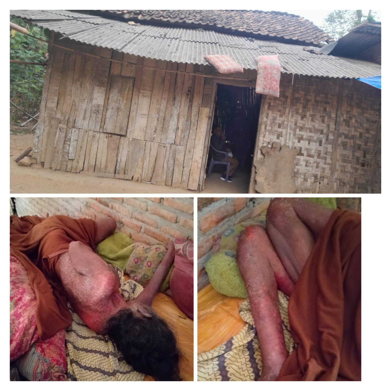 Sunyi di Sindang Garut: Bertahun-tahun Ibu Suanah Berjuang Melawan Kulit Melepuh dalam Keterbatasan