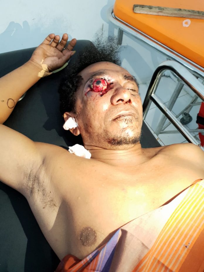 Senggolan di Acara Joget, Pimred alifurunews.com Dianiaya Hingga Bola Mata Nyaris Copot