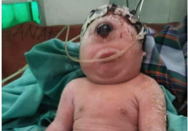 Bayi Perempuan Mirip “Dajjal” Lahir Bermata Satu Tanpa Hidung di Sumatera Utara