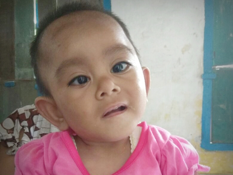 Aisyah Az-Zahra Balita 1 Tahun Pengidap Rubella