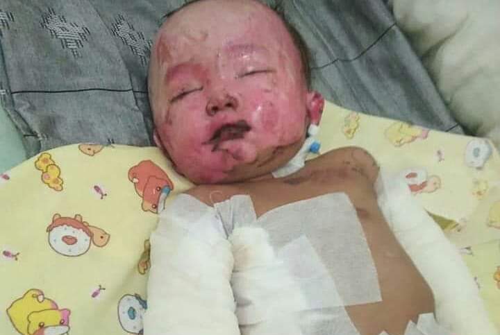 Balita Tersiram Tumpahan Air Nira Mendidih Dan Abu Panas Butuh Bantuan