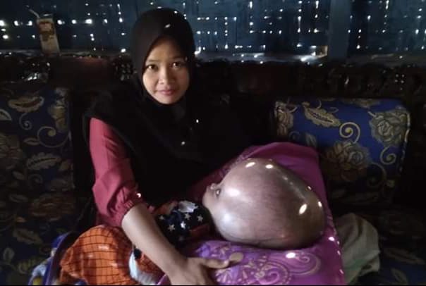 Adrian Bayi Hydrocephalus Keluarga Miskin Butuh Bantuan