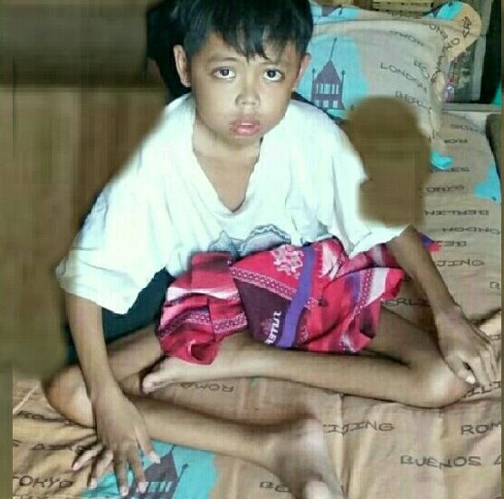 Riski Julianto Bocah Miskin Yang Lumpuh Layu Tangan dan Kaki di Tanggamus