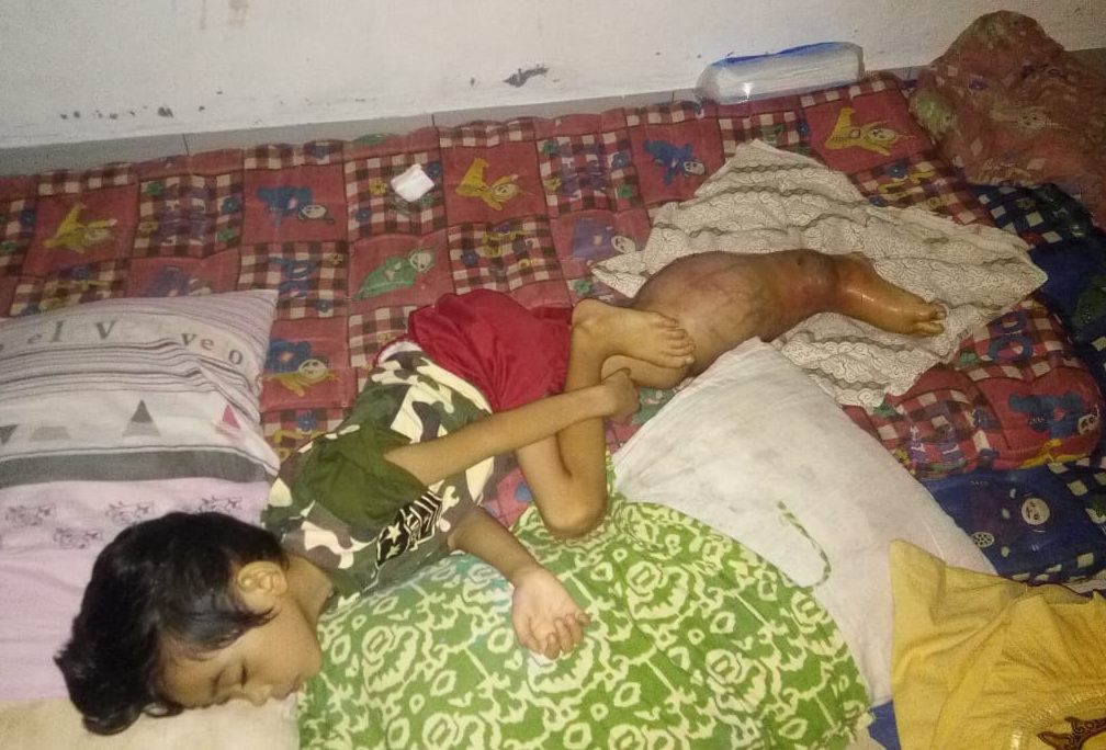 Naufal (5) Penderita Tumor Kelenjar Kaki Kanan Membengkak, Minta Bantuan Bupati Tanggamus