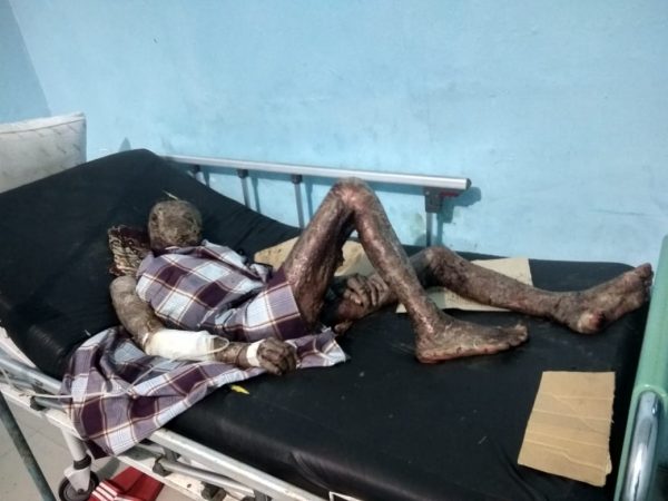 “Buruknya” Pelayanan RSUAM Terhadap Marji Si Miskin Pasien Suspect Steven-Johnson di Ruang Isolasi Beralas Kadus?