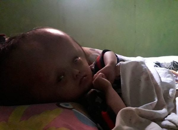 Atizah Balita 4 Tahun Penderita Hydrosefalus Sejak Dalam Kandungan Tak Pernah Ditangani Medis