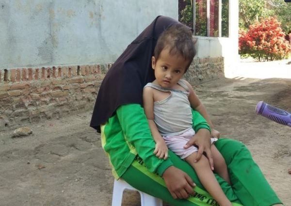 Balita Anak Penyadap Karet Penderita Hydrosipalus Tak Tersentuh Pemda Tulang Bawang Barat