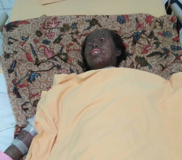 Pasca Operasi Caesar Sekujur Tubuh Mulyani Melepuh