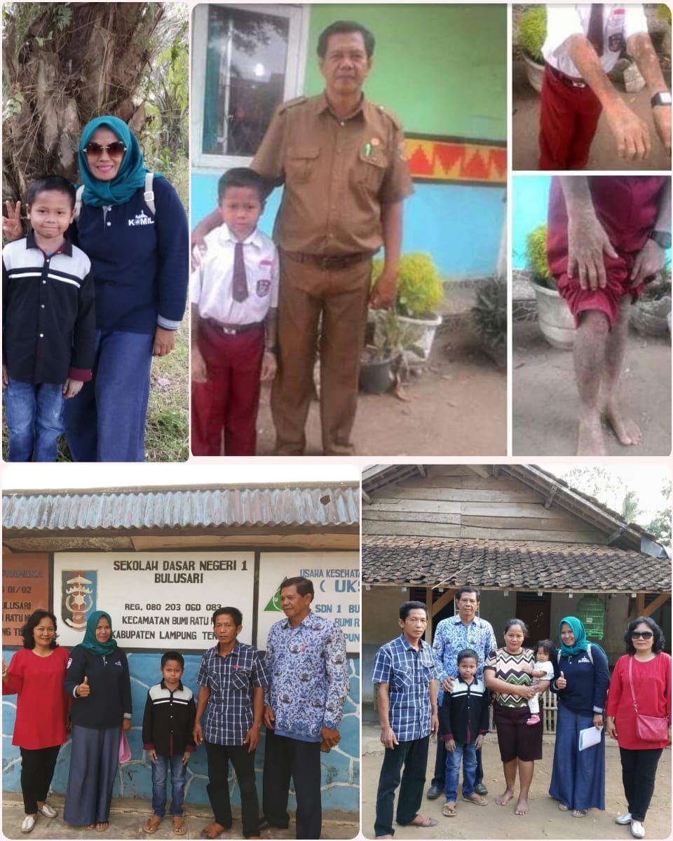 Alami Kelainan Kulit Sejak Kecil, Jaka Membutuhkan Bantuan