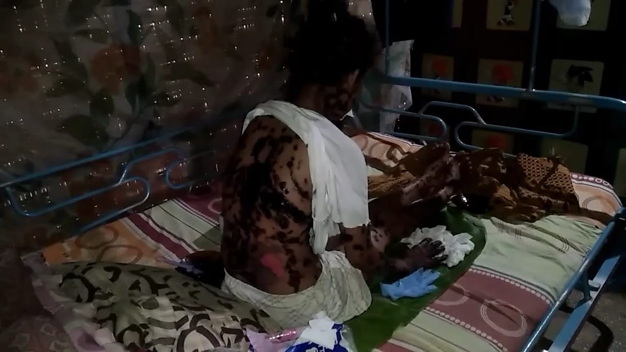 Derita Penyakit Langka, Sunaini Hanya Bisa Terduduk Lesu