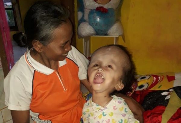 LSM Pijar Keadilan Lamtim Jenguk Safira, Balita Pengidap Hydrocephalus