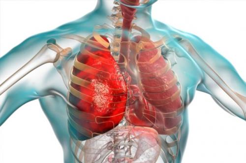 Pasien Suspeck Virus Corona di Jawa Tengah di Rawat di RSUP dr Kariadi Semarang