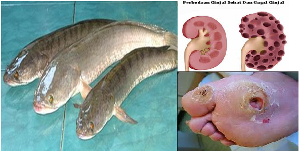 Manfaat Ikan Gabus Untuk Diabestes