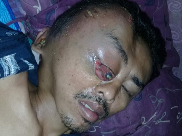 Menderita Tumor Otak Suwarno Tak Mampu Berobat Sempat Dikunjungi Kapolsek Pugung