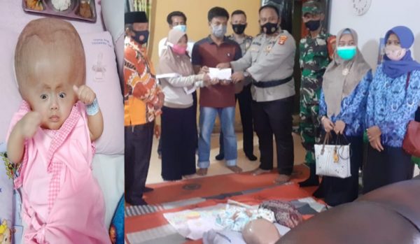 Aipda Husni Tamrin Galang Dana Bantu Biaya Pengobatan Radhitya Penderita Hidrosepalus