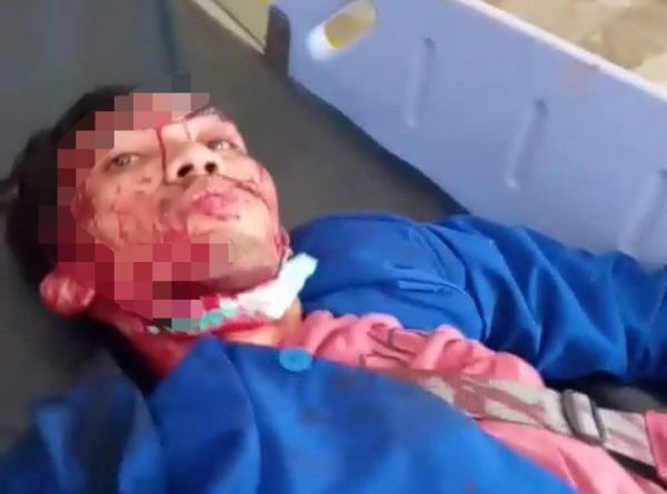 Dua Mahasiswa Pelita Bangsa Masih Dirawat Satu Operasi Kepala Luka Tembak Peluru Karet