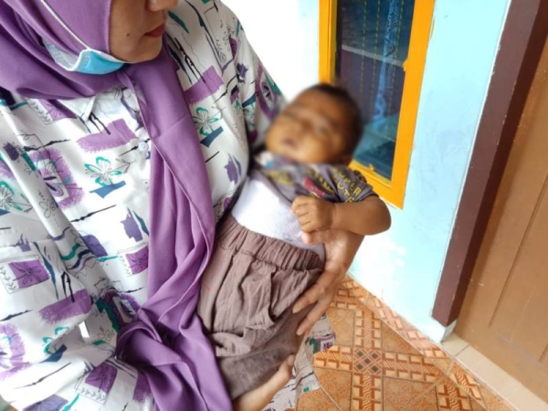Balita Penderita Obstructive Joundice Butuh Ulurang Tangan Kita