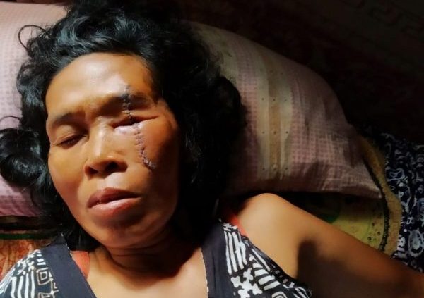 Mertua Bacok Anak Mantu di Sukadana, Pelaku Masih Berkeliaran Suami Enggan Lapor Polisi Karena Pelaku Ayahnya