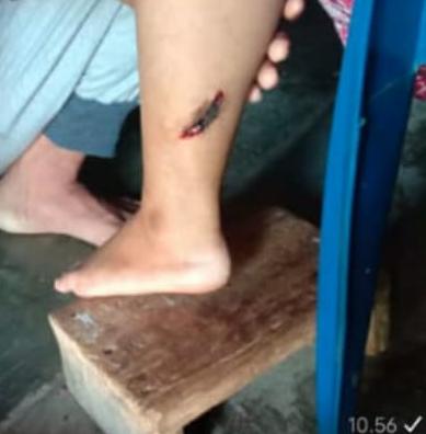 Masuk ke Sungai, Kaki Warga Cukuh Balak Digigit Buaya