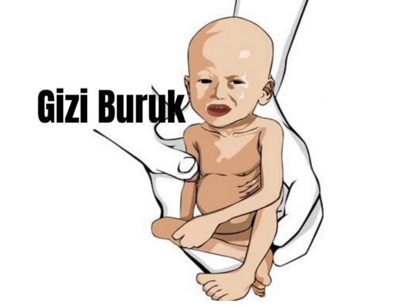 Tubaba Gizi Buruk Tertinggi di Lampung, DPRD Provinsi Prihatin Tapi Kadinkes Majril Membantah