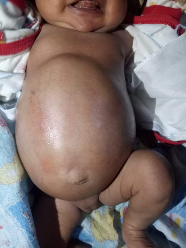 Perut Seorang Bayi Tiba-tiba Membesar, Butuh Para Dermawan dan Sentuhan Pemkab Tanggamus