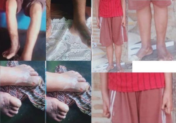 Talang Padang Waspada Kusta