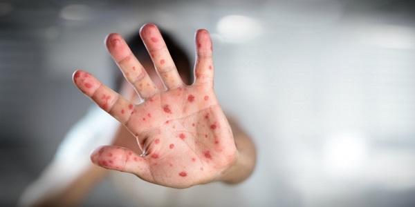 Setop ‘Ngesek Sembarangan’ Cara Ampuh Hindari Tertular Cacar Monyet