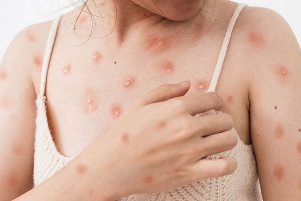 Ditemukan 23 Kasus Kasus Aktif Cacar Monyet di Jakarta, Lampung Bagaimana?