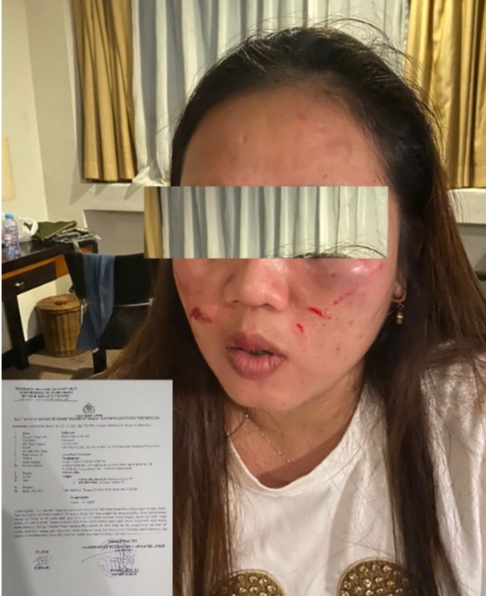 Gara-gara Temuan Hasil Audit BPK Terkait Perjalan Dinas DPRD Tanggamus tahun 2023 Staff Pendamping Komisi DPRD Tanggamus Aniaya Rekannya Hingga Luka Parah