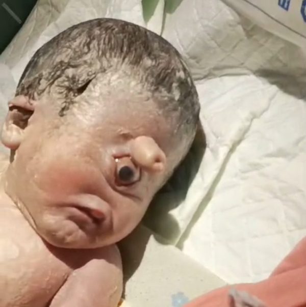 Bayi Mata Satu Lahir di Sekayu Gegerkan Warga, September 2018 Lalu Pernah Ada di Medan